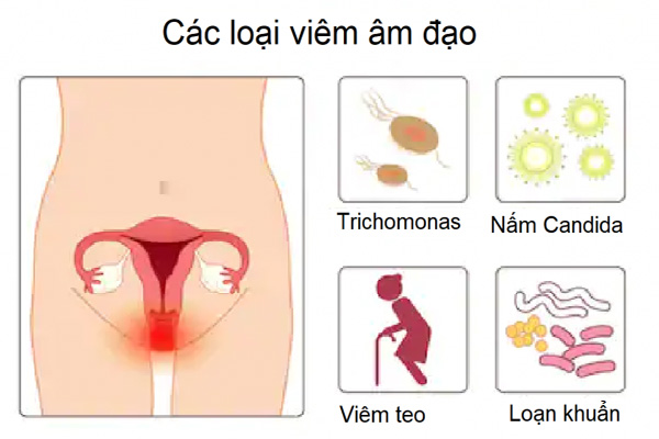 Lợi ích của men vi sinh phụ khoa