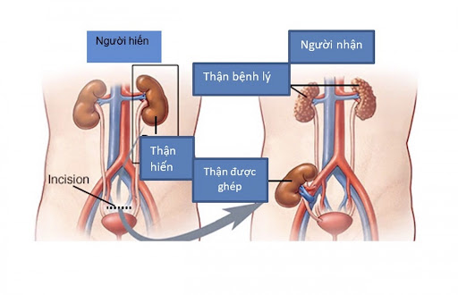 Bệnh suy thận khi nào cần lọc máu