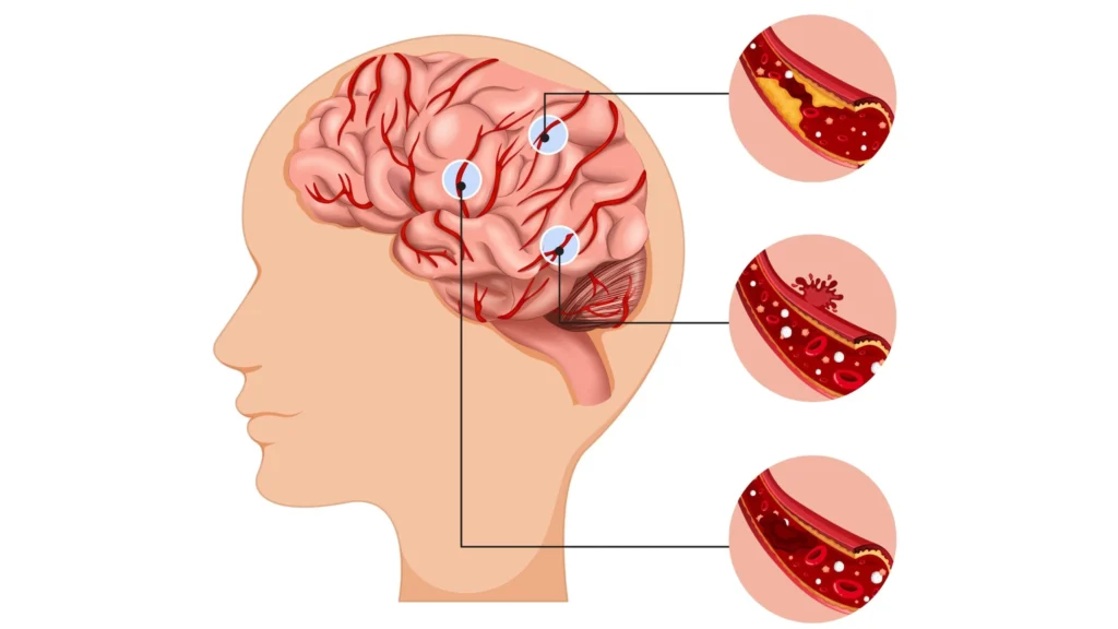 Dấu hiệu nhận biết sớm Đột Quỵ