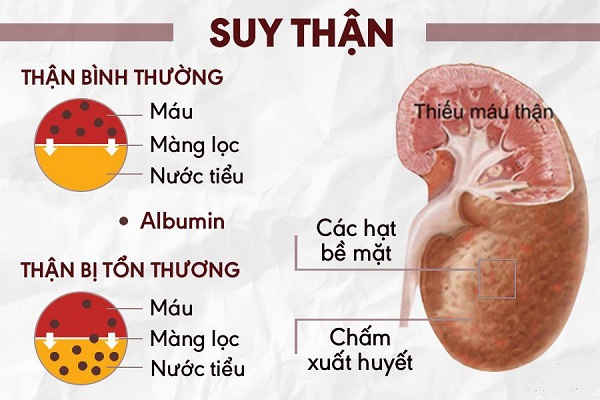 Phân biệt suy thận cấp và suy thận mạn