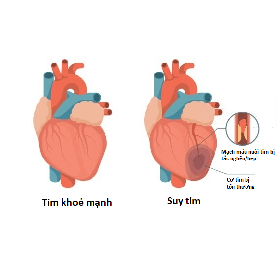 Triệu chứng Suy Tim